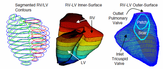 ADINAショーケース 2010FSI in Virtual Heart Surgery